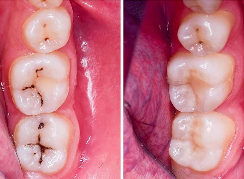 before and after dental treatment