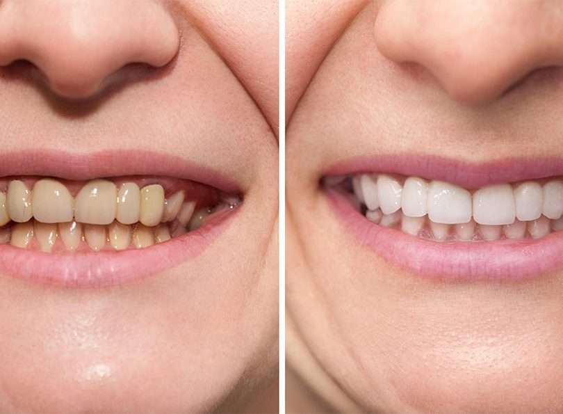 before and after dental treatment