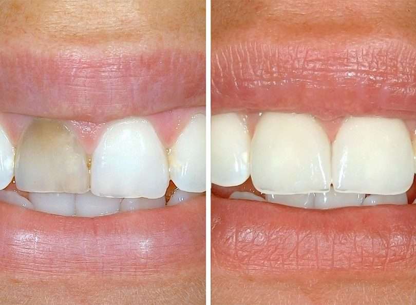 before and after dental treatment