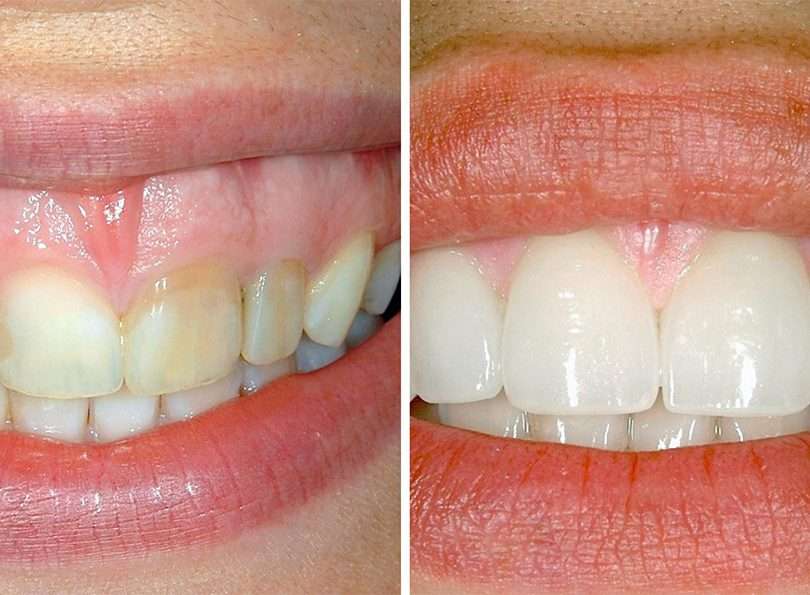 before and after dental treatment