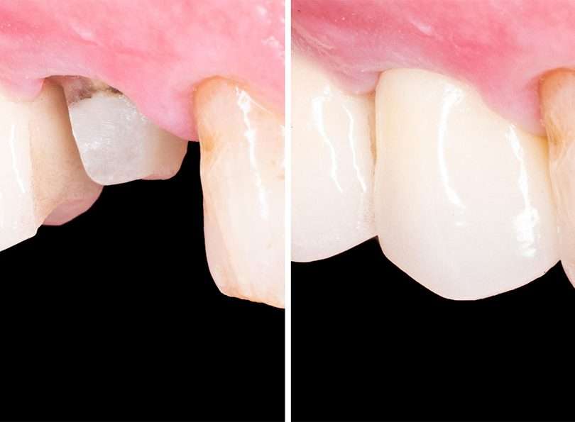 before and after dental treatment