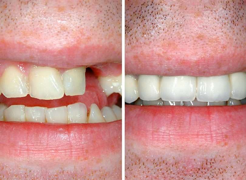 before and after dental treatment
